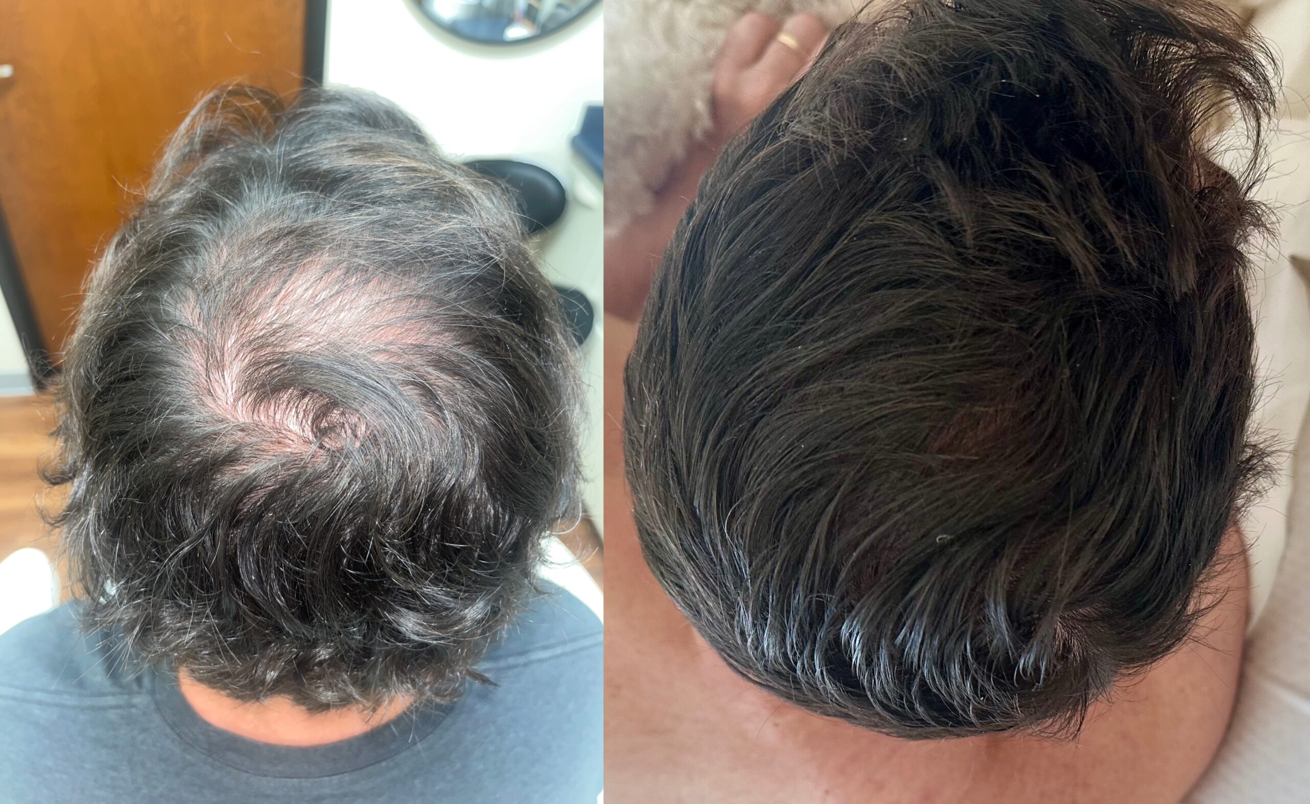 Hair Loss Treatment Valencia, CA