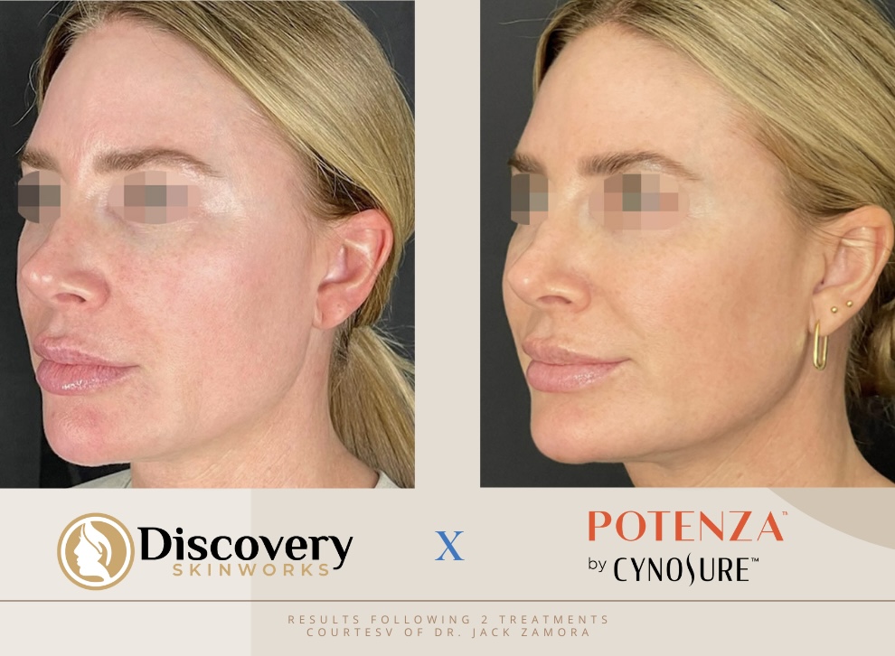 Potenza RF Microneedling