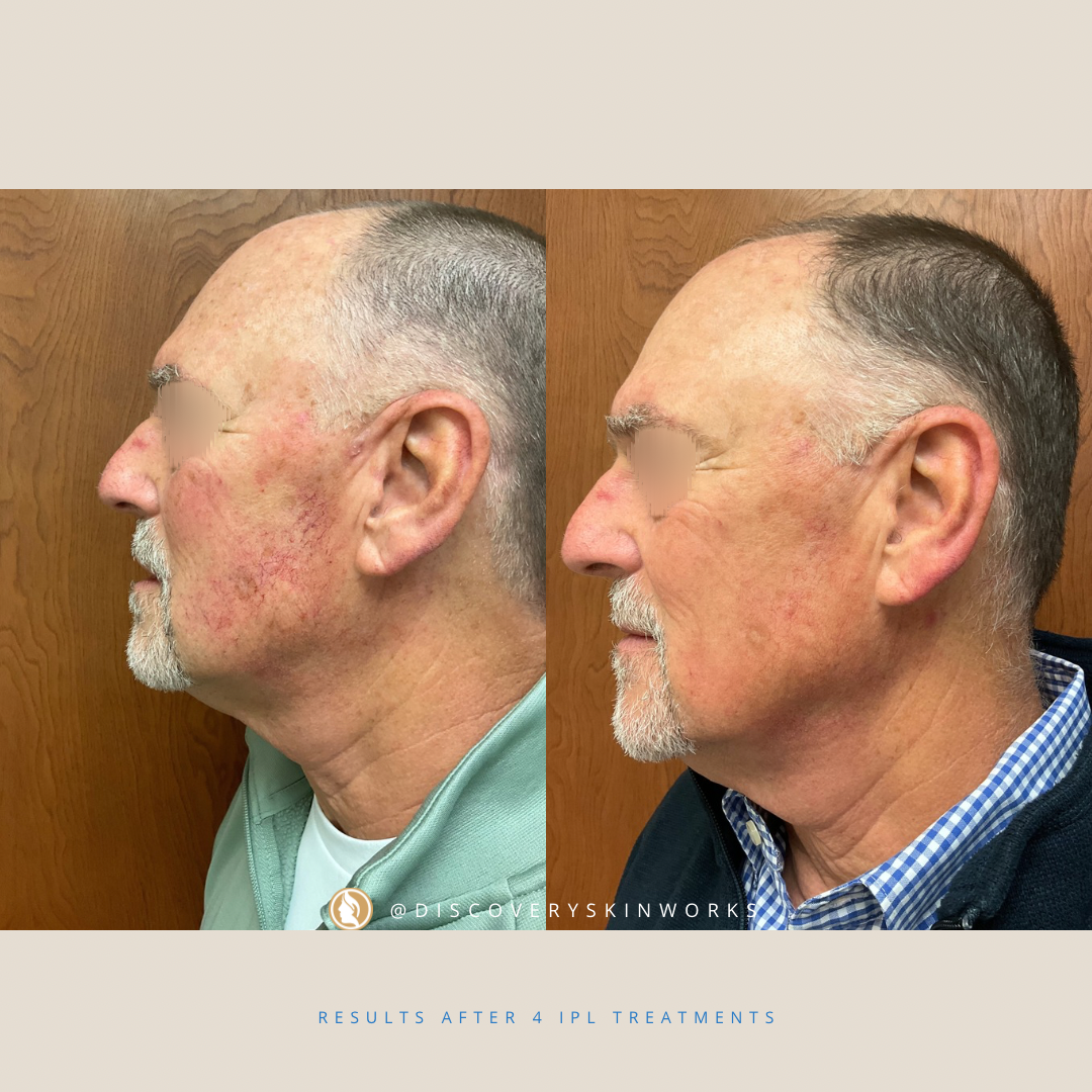 Valencia IPL Photofacial