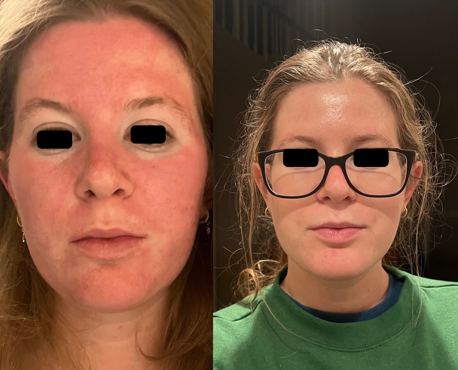Rosacea Treatment Santa Clarita, CA
