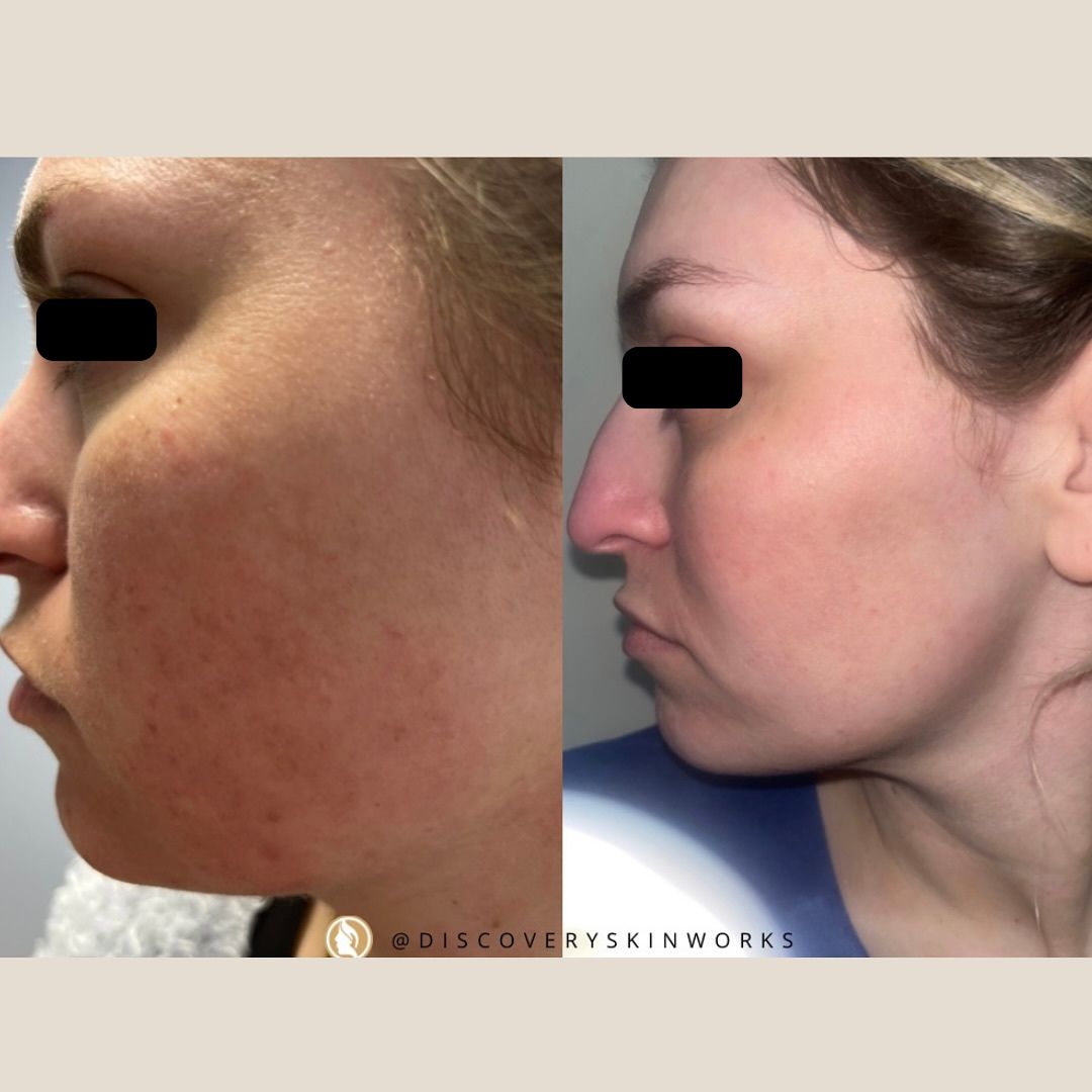 Santa Clarita Acne Scar Treatment
