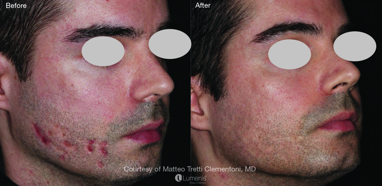 Fractional Laser (ResurFX)