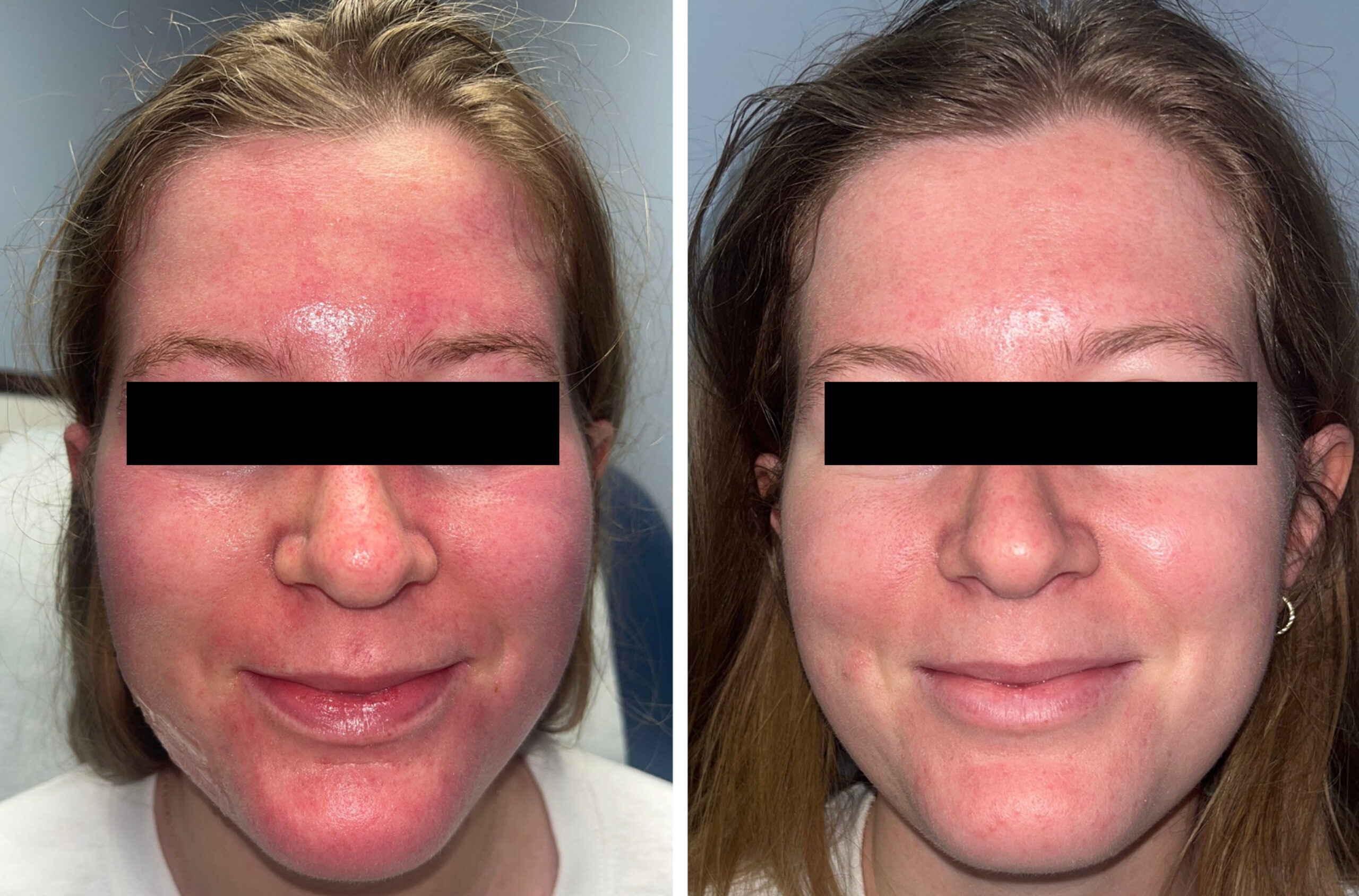 Before and After First IPL Treatment