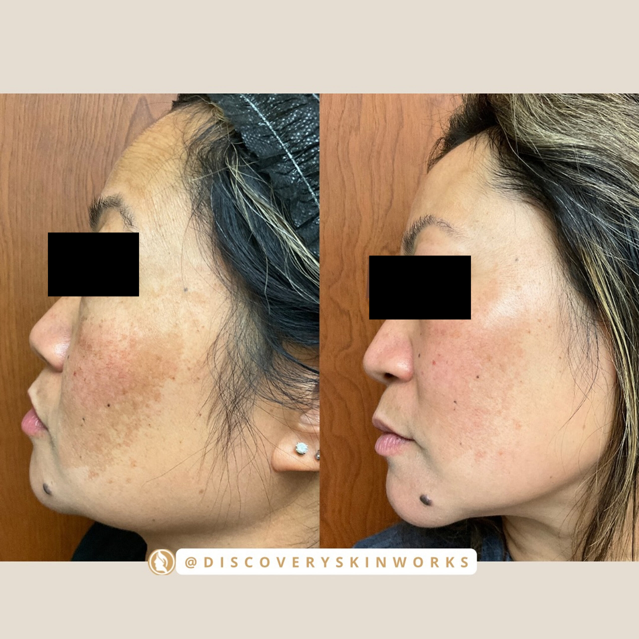 Melasma treatment - mid protocol in our GlowWorks approach, a customized alternation of Potenza RF Microneedling and LaseMD Ultra every 2 weeks, with tranexamic acid applied post Ultra.
