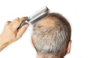 hair loss treatment in Valencia, CA