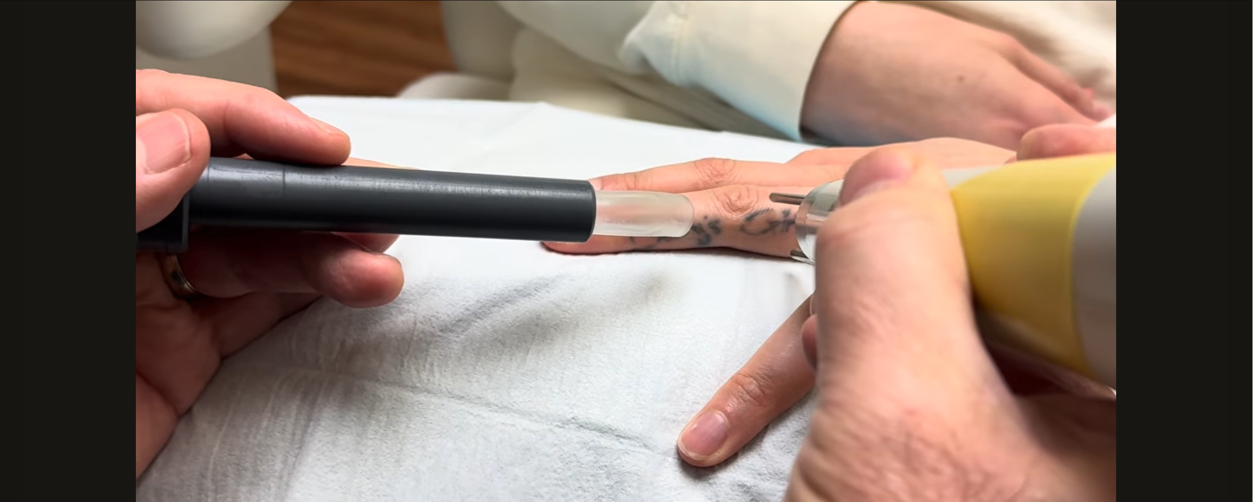Discovery Skinworks x ZAP that TATT Finger Tattoo Removal