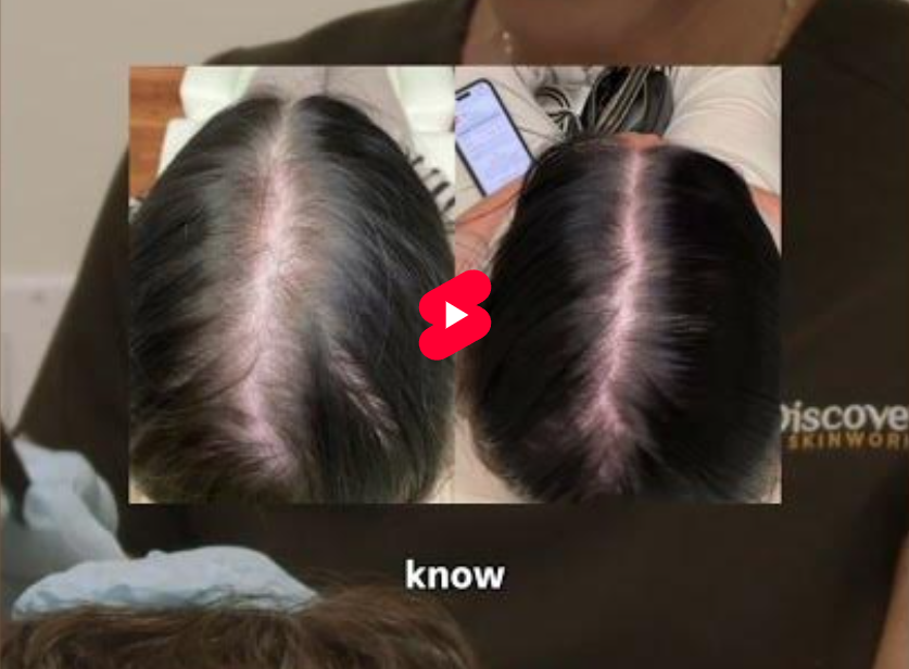 Medical Options For Hair Thinning
